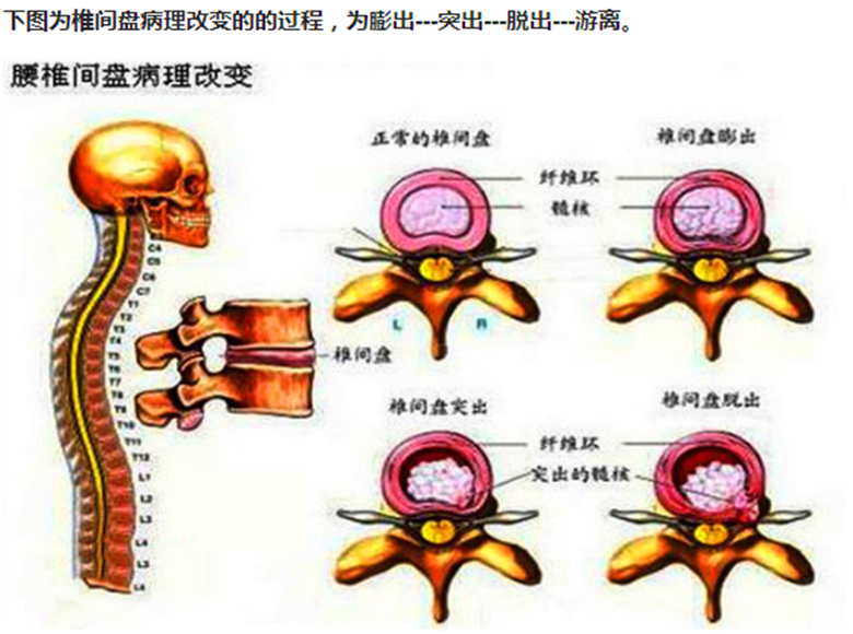 您好,我男朋友32岁,腰椎间盘突出,位置是腰5骶1,请问这个位置严重吗?