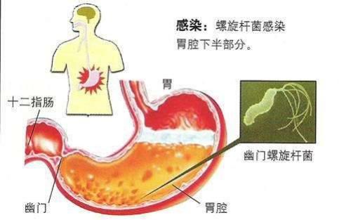 幽门螺杆菌阳性的人,打死都不能碰的3种食物是什么?