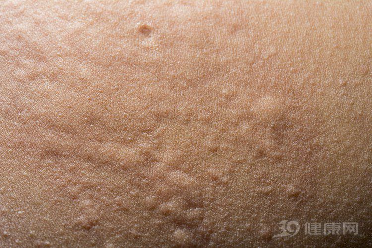急性荨麻疹图片_纵览新闻