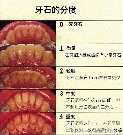 长了大块牙结石,口臭,反反复复难根除,教你2个方法