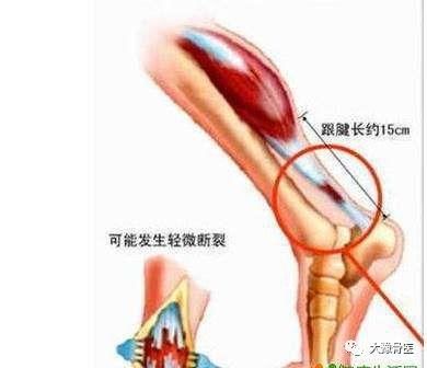 高考季,请保护好你的跟腱
