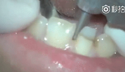 做烤瓷牙全过程,看看牙齿是怎么被磨小的!