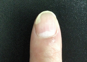 灰指甲初期囹a!&-ZK