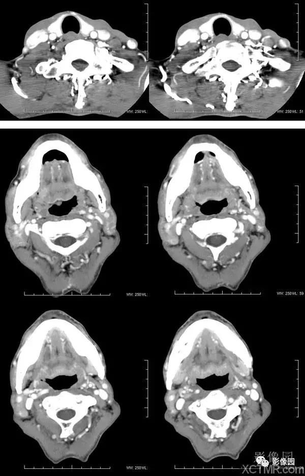 咽喉癌ct病例图片影像诊断分析!