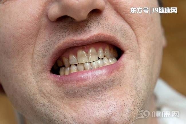 牙齿的黄垢既难看,又不卫生,让人容易自卑,烦恼.