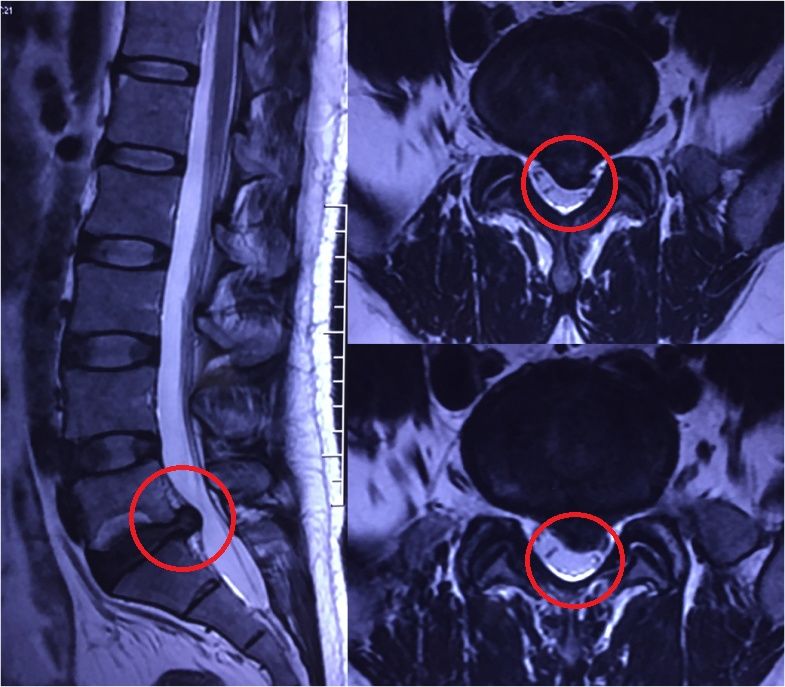 腰椎间盘突出症(l5/s1,msu分型 3-a).