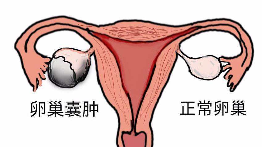 卵巢囊肿会引发不孕,导致下腹胀痛,腹部和四肢水肿,甚至引发癌变,对