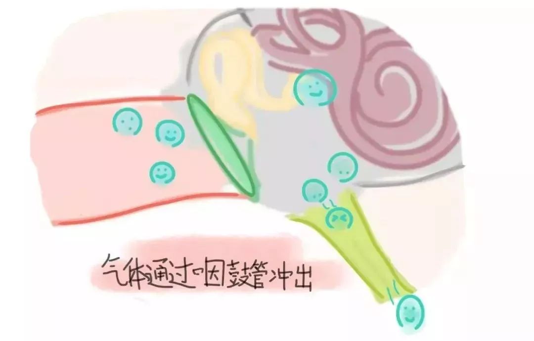 鼓膜内陷,鼓膜积液,鼓膜位置_大山谷图库