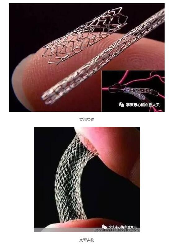 心脏支架(stent)又称冠状动脉支架,是心脏介入手术中常用的医疗器械