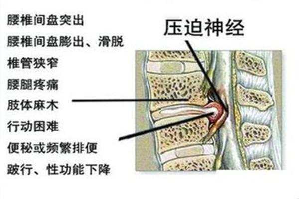 腰椎间盘突出困扰很多人,腰间盘突出压迫神经这样解决