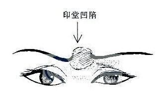 印堂长有疤痕,凹陷不平,恶痣,恶纹侵破,长有锁眉,为相眄不佳.