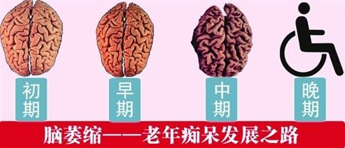 7,大脑半球发育不全或多因素所致大脑半球萎缩.