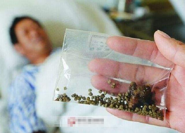 肾结石很严重怎么办?