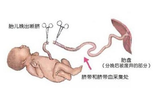 经鉴定,婴儿系产后被锐器割断脐带未结扎合并刺破右侧颈内静脉致大