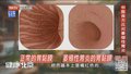中医良方应对萎缩性胃炎