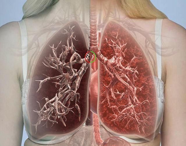 正常人的肺部图片真实图片