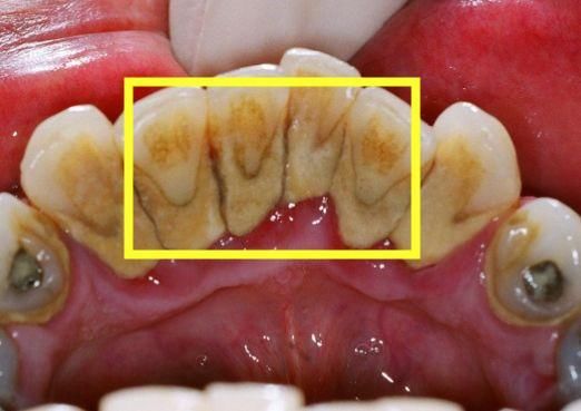 快速消除牙结石的小方法,在家抽出5分钟就能搞
