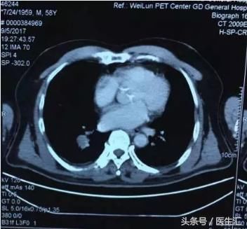 PET-CT提示肺癌多发转移,多次活检阴性的患者