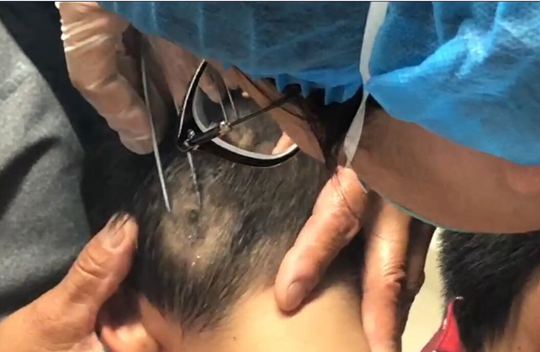 拨开孩子头发，家长被吓坏!有人因此死亡，此病还可人传人