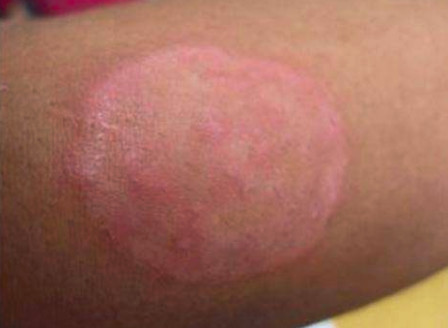 铜钱癣的治疗怎么快,解决皮肤藓的方法