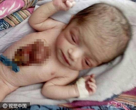 Hemlata 现在正在等待手术。