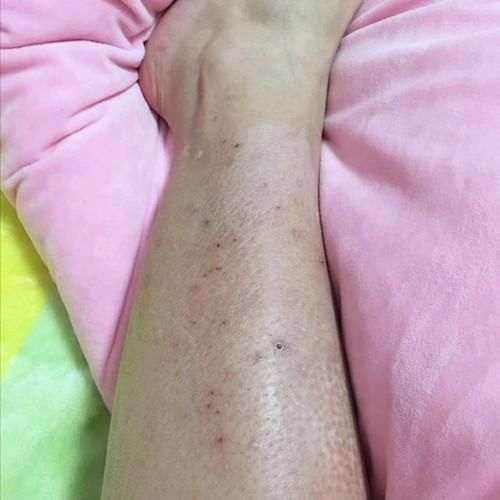 孕妇全身瘙痒,婆婆劝说就医反被骂,孕7月早产