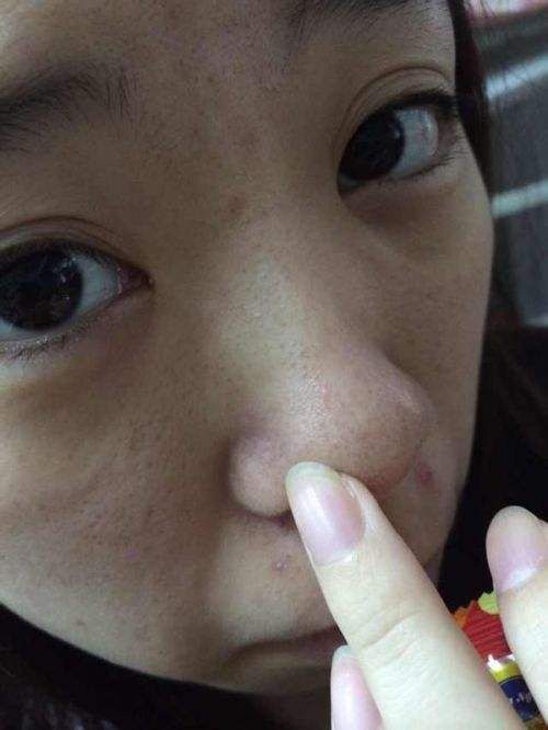 鼻子两侧挤出白色长条分泌物是什么?你知道吗