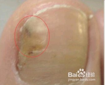 指甲上有竖纹是怎么回事?大拇指上有些凹凸不