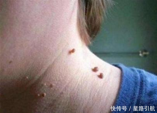 身上这些地方长出了肉疙瘩是怎么回事