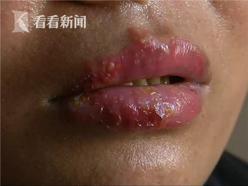 女子漂唇几天后嘴唇起泡溃烂 资讯 315记者摄影家