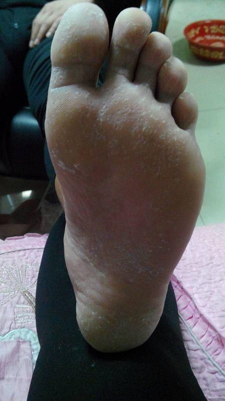 得了糜烂型脚气要及时治疗!