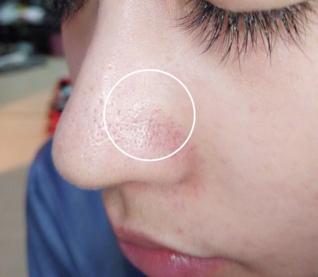 鼻子挤出的小颗粒太多,是螨虫的排泄物凝固,怎