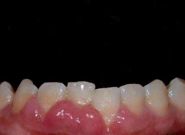 糖尿病患者别担心,它是糖尿病克星,饭后吃一点,有效降血糖