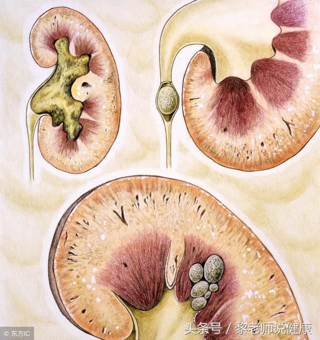 每日1剂,日服2次,连服5天,肾结石不痛了,还能有助于排石,见效快