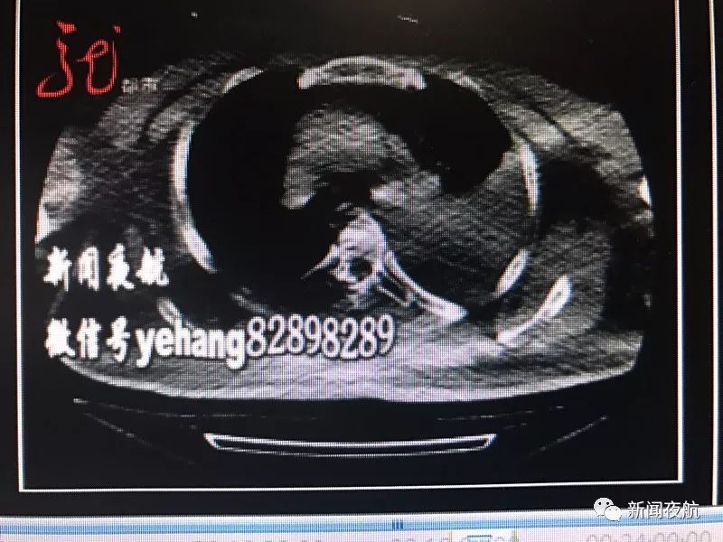 真扎心了!一男子心脏被刀扎伤喷血高达2000毫升