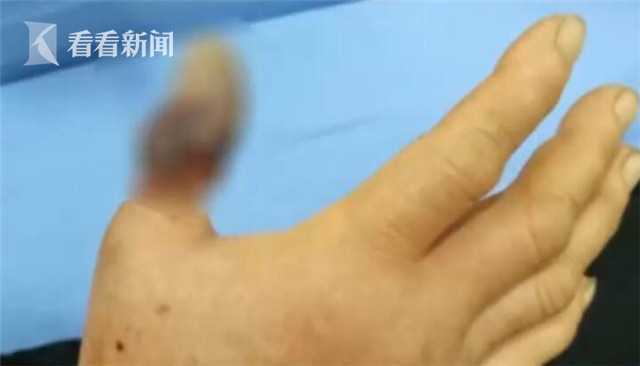 阿姨拇指被蛇咬险被截肢 只因当时做了这件事 阿姨拇指被蛇咬险被截肢 只因当时做了这件事