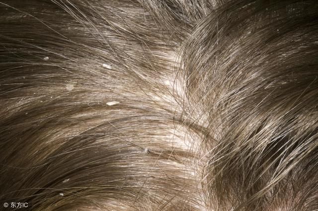 直言不讳:头上5现象,是螨虫伤害头皮没商量,除