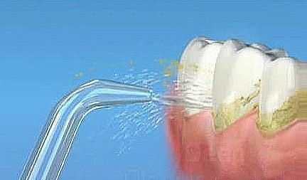 洗牙是怎么洗的?会不会伤害牙齿