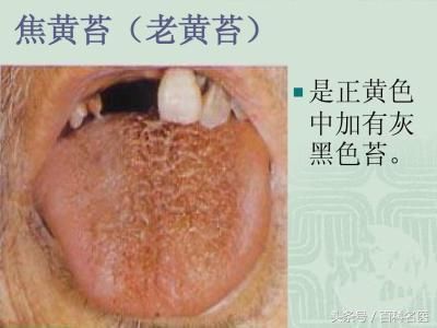 从舌头看人体健康:舌苔发黄怎么回事?吃什么食