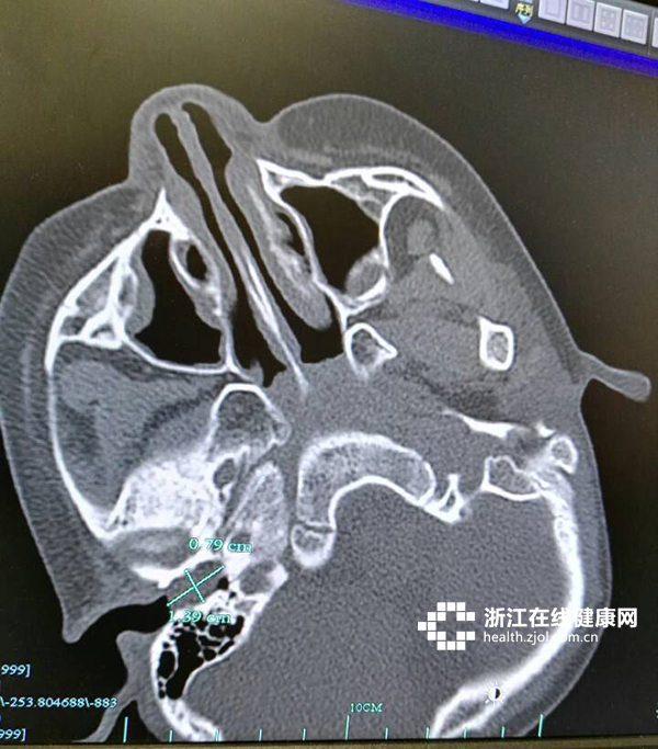 ct下赵赵的耳朵里有一颗"指甲"大小的耳屎从小到大没有挖过耳屎已经有