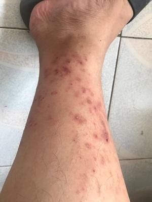 治湿疹 古人只认一条路 听说很多人都走通了!-