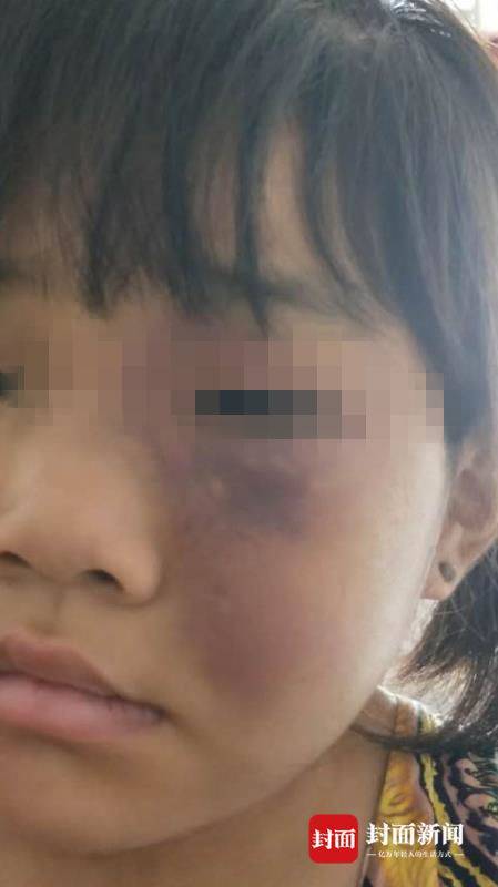 女童被家人吊打满身伤痕 警方:不做作业被母亲打骂