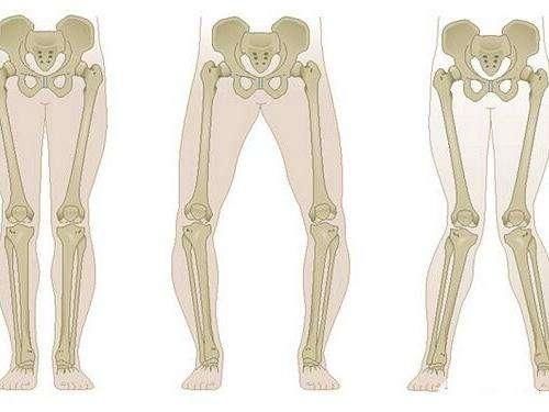 2岁的宝宝走路八字脚是什么原因?3个方法,为