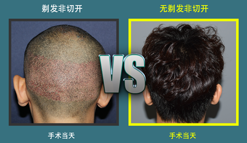 韩国植发靠谱吗,发际线移植效果怎么样?