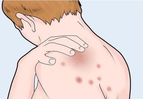 湿疹高发季,管它是急性亚急性还是慢性,一个简