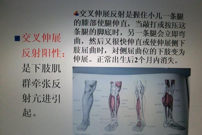 交叉伸展反射阳性:是下肢肌群牵张反射亢进引起.