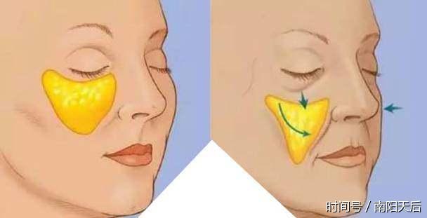法令纹太深怎么办?这个做法会让你越填越深
