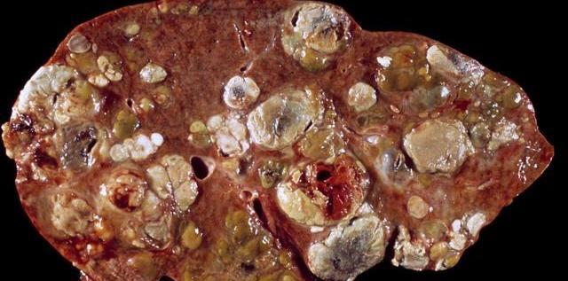 喝酒后身体这2个地方发红的人,不能喝酒,肝脏