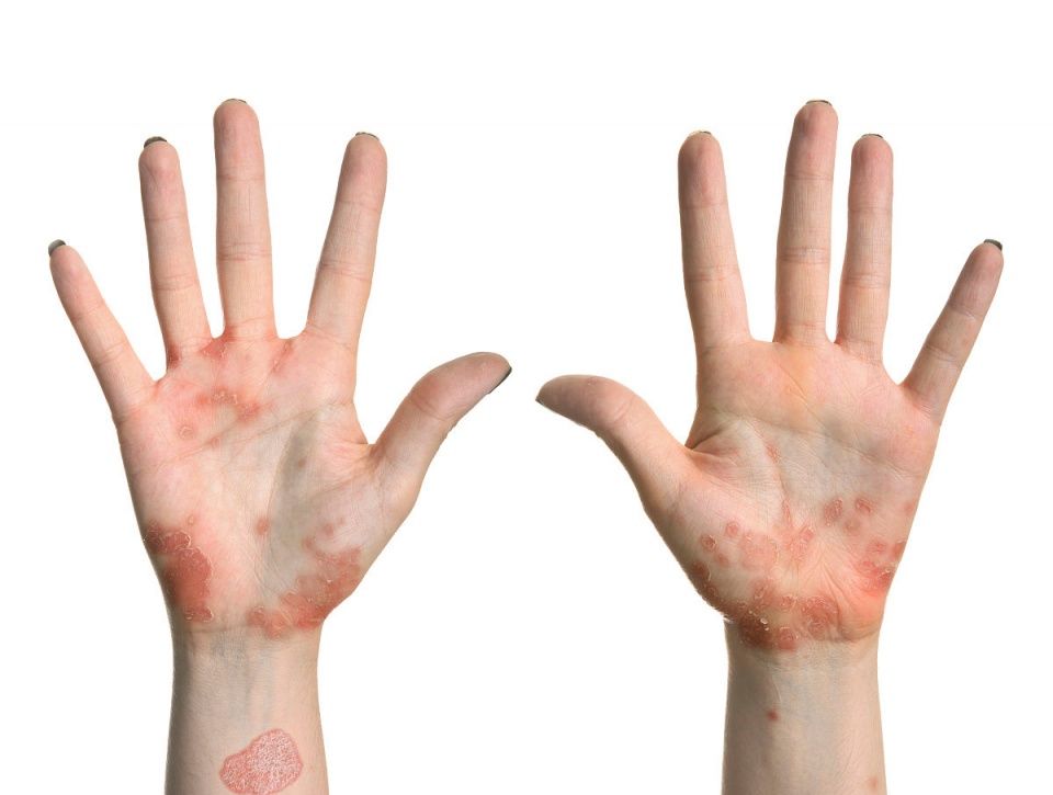 湿疹的克星,生理盐水加1物,杀菌止痒,解你湿