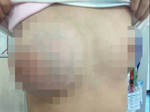 浙江12岁少女乳房疯长 注意乳房发育中出现的危险信号